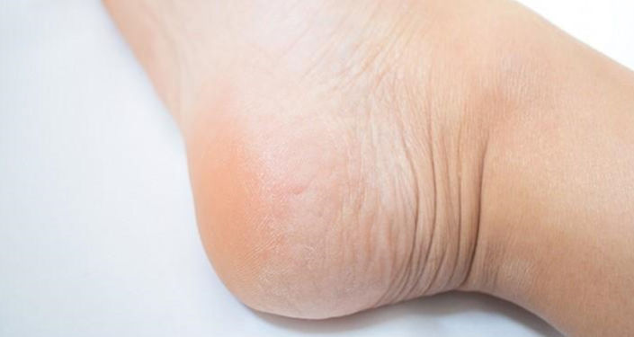 足に角質が溜まる主な原因2つ